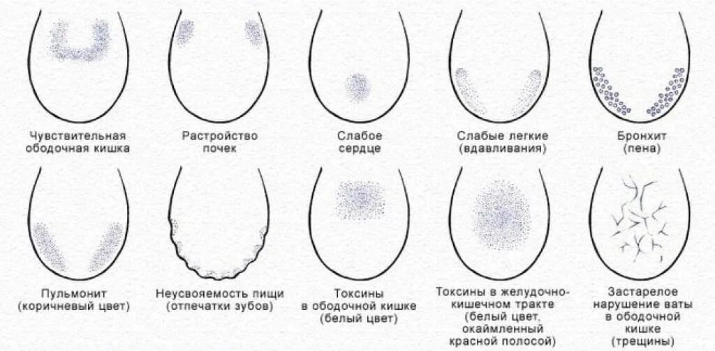 Географическая форма языка. Заболевания по цвету языка. бороздки на языке причины.