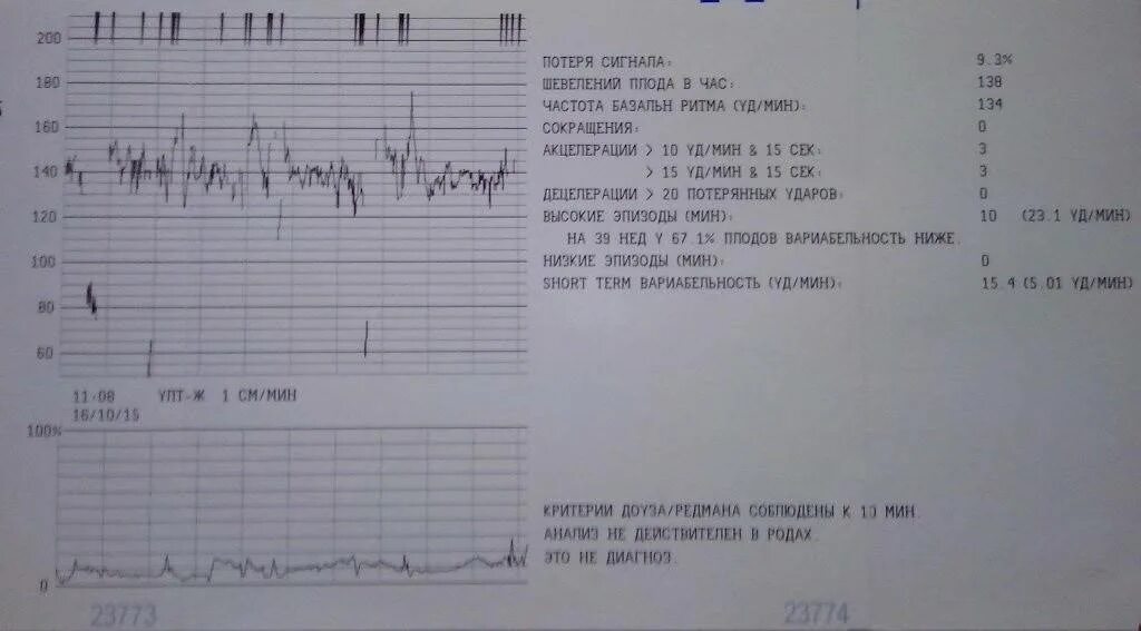 Норма КТГ В 33 недели. КТГ на 33 неделе беременности. КТГ норма 34 неделя беременности норма. Ундулирующий ритм на КТГ.