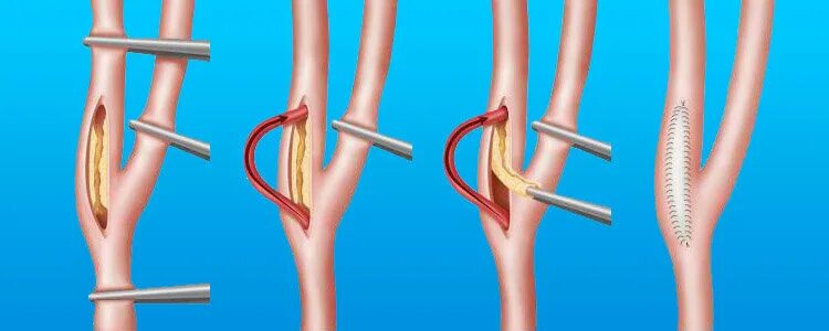Операция шунтирование артерии. Эндартерэктомия атеросклероз. Эверсионная эндартерэктомия. Шунтирование и стентирование. Операции артерий каротидная эндартерэктомия.