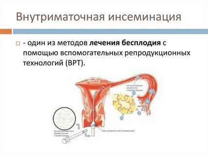 Искусственная инсеминация