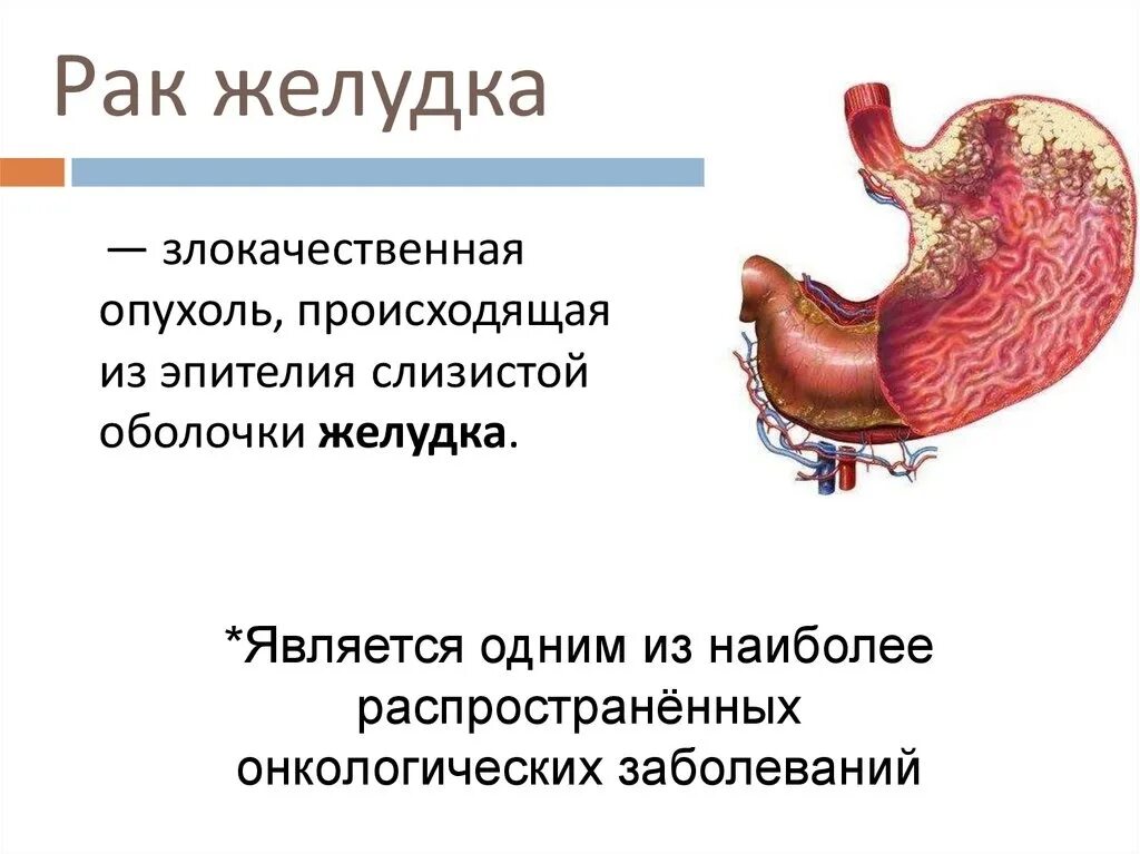 Как развивается рак желудка. Онкологические заболевания желудка. злокачественные заболевания желудка. новообразование на слизистой желудка. злокачественное новообразование желудка.