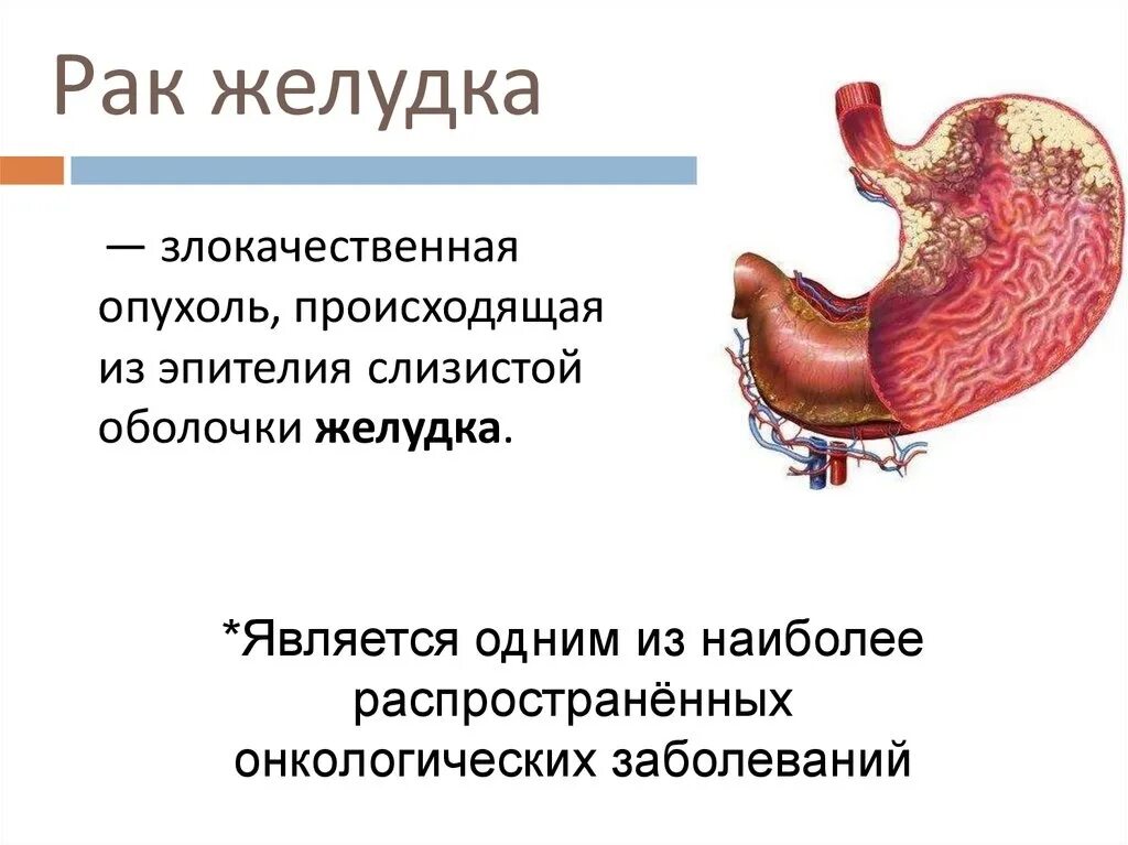 Предраковый гастрит. Онкологические заболевания желудка. Злокачественные заболевания желудка. Новообразование на слизистой желудка. Злокачественное новообразование желудка.