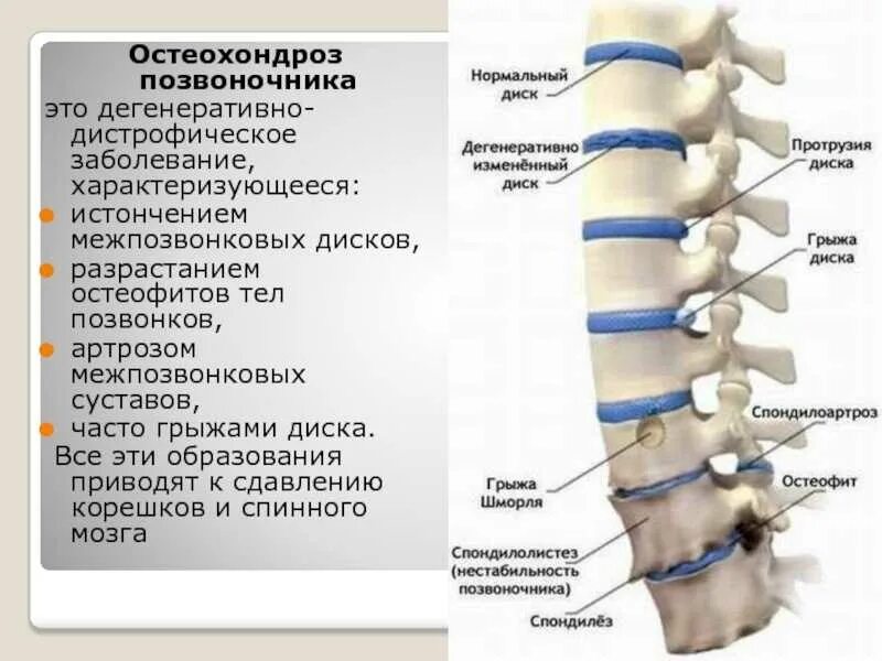 Болезнь шейерманна - мау. Компрессия корешков l5 s1. Остеохондроз деформирующий спондилоартроз и спондилёз. Поясничный остеохондроз l1 l2 периоды. Спондилоартроз грыжа диска.