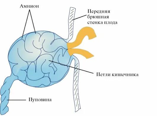 Пуповина схема прикрепления к матери. Патология прикрепления пуповины.