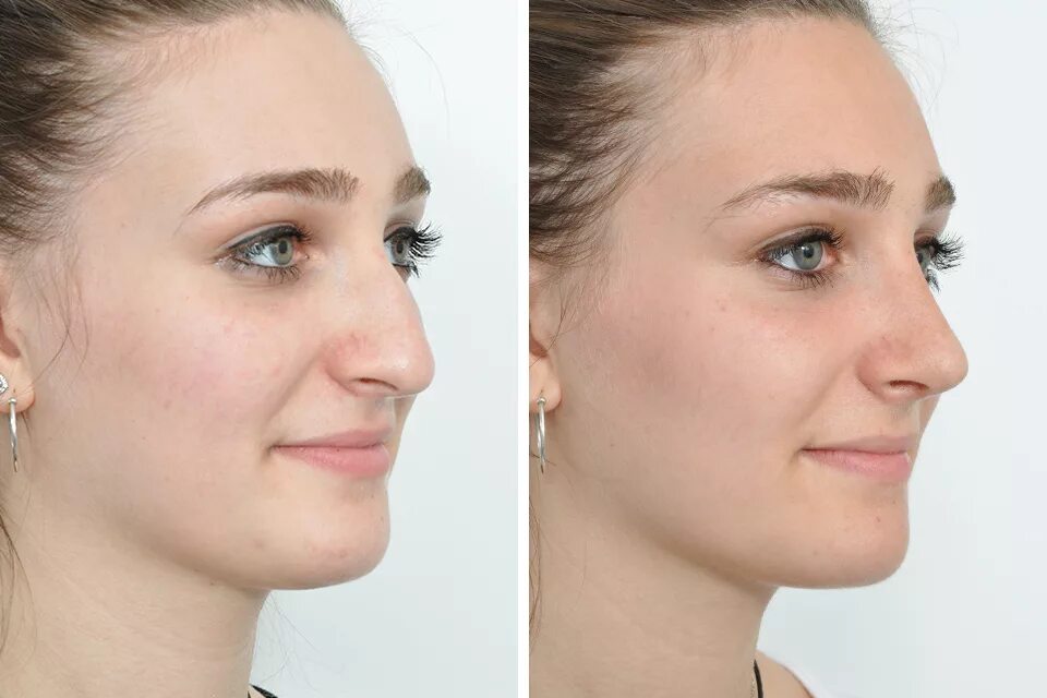 Клиника нос операция. Ринопластика. Ринопластика носа. Пластическая операция на нос. Ринопластика до и после.