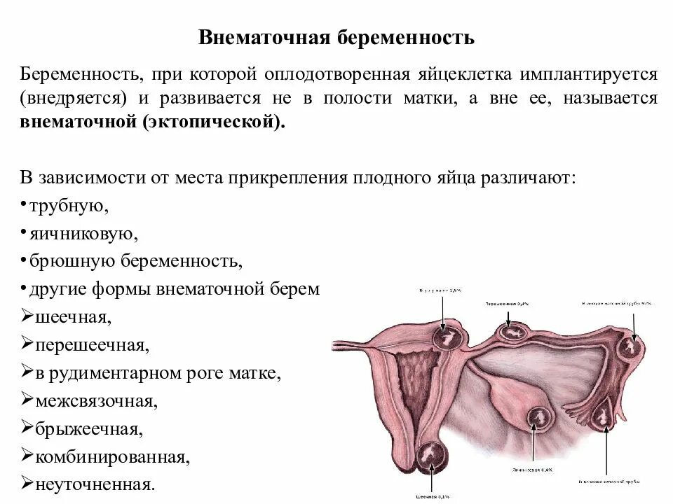 Как выявить внематочную