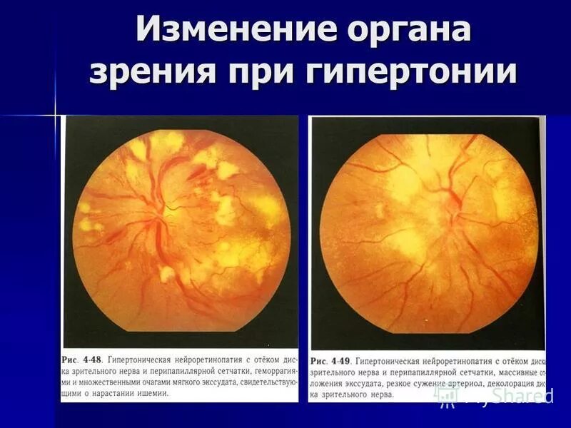 Опухоли зрительного нерва глазное дно. Отечный диск зрительного нерва. Изменения глазного дна при гипертонической болезни. Гипертоническая болезнь изменения на глазном дне.