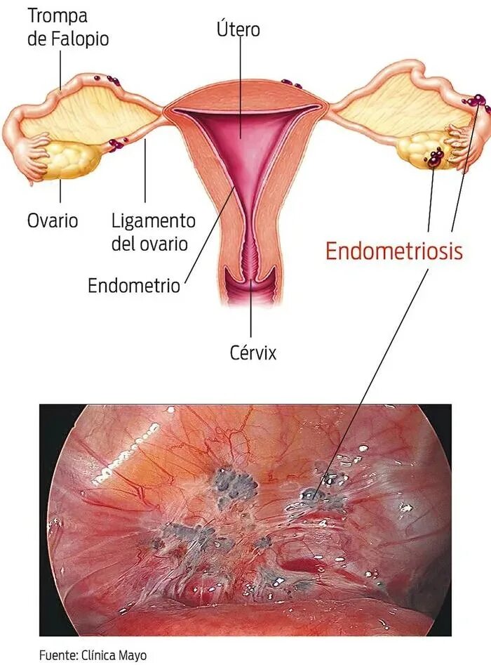 Эндометриоз фаллопиевых труб. Наружный эндометриоз шейки матки. Болезненные менструации. Эндометриоз.