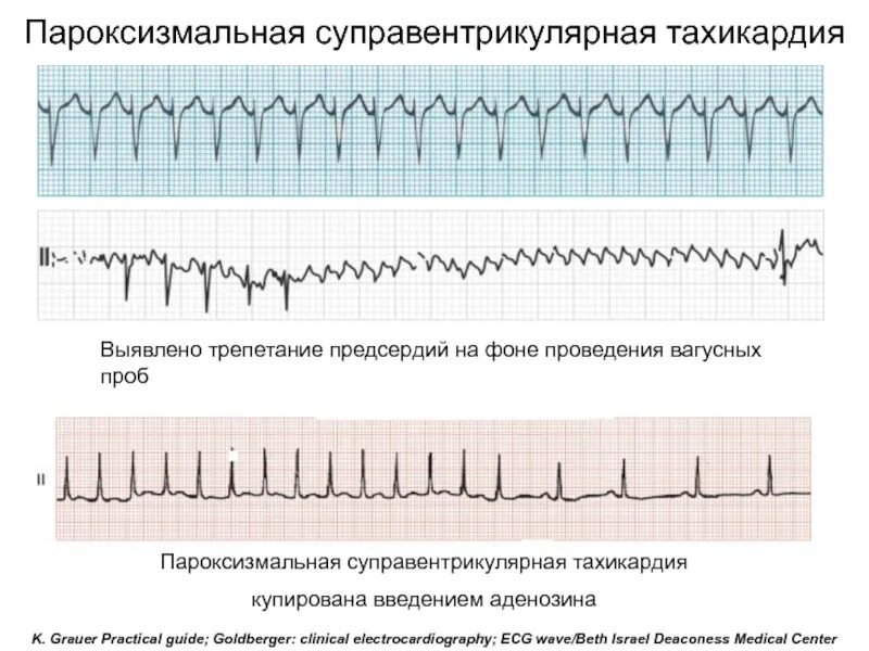 Чем отличается аритмия от тахикардии