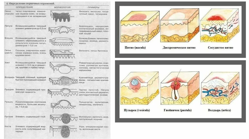 Вторичные элементы поражения