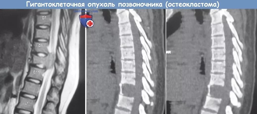 Рак поясницы. Хондрома позвоночника кт. Плазмоцитома позвонка мрт. Гигантоклеточная опухоль позвонка мрт. Остеохондрома позвонка.