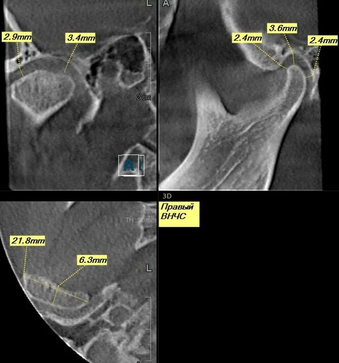 Артрит кт. Артрит височно-нижнечелюстного сустава рентген протокол. Магнитно-резонансная томография артрит ВНЧС. Ревматоидный артрит ВНЧС кт. ВНЧС на кт норма и патология.