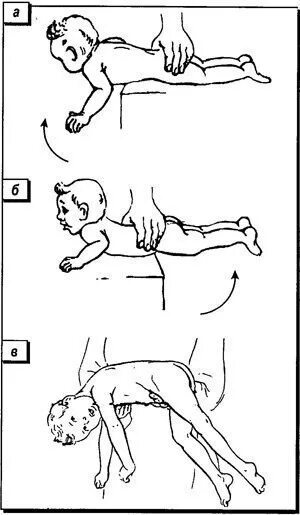 Верхний рефлекс Ландау. Лабиринтный тонический рефлекс новорожденного. Лабиринтный установочный рефлекс у детей. Рефлекс Ландау у новорожденных верхний и Нижний.