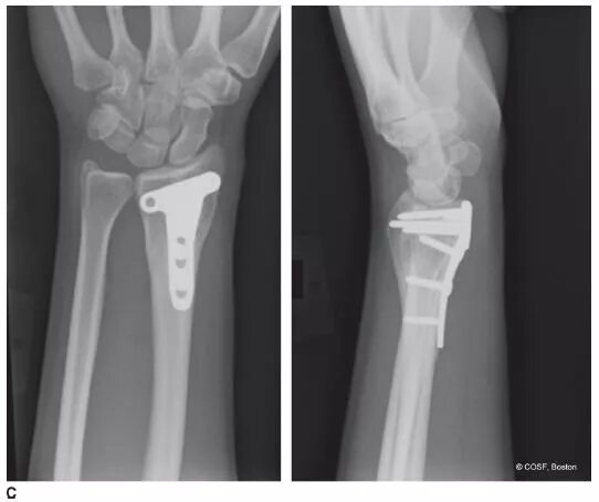 Radius fracture. Orif proximal phalanx intra articular fracture. distal end.