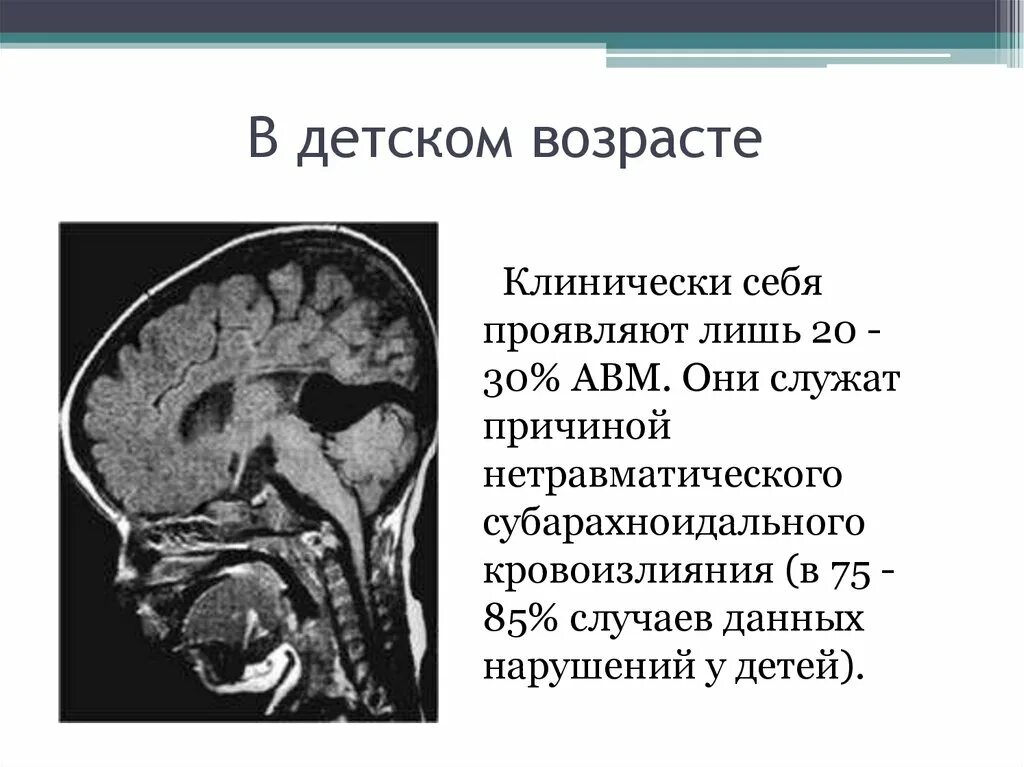 Что такое мальформация головного мозга. Артериовенозная мальформация головного мозга на кт. венозная мальформация головного мозга. мальформация сосудов головного мозга кт.