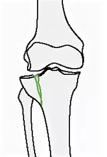 Перелом мыщелка большеберцовой кости. Внутрисуставной перелом мыщелка большеберцовой. Переломы мыщелков большеберцовой Кост. Перелом наружного мыщелка большеберцовой кости.