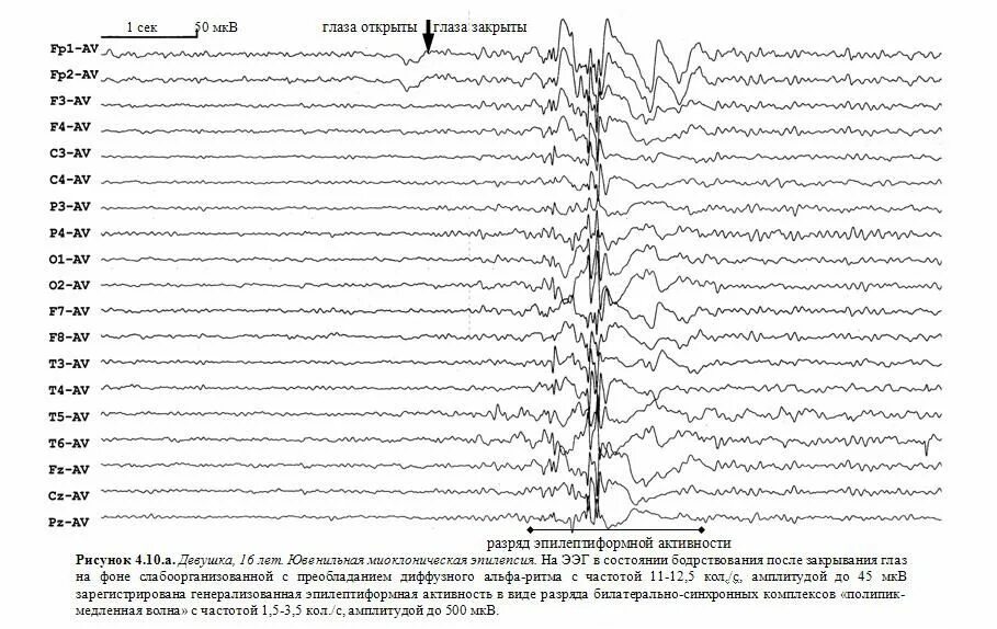 Эпилептиформная активность на ээг у ребенка. Депрессия Альфа-ритма ЭЭГ норма. Десинхронизация ЭЭГ В виде депрессии Альфа ритма. Нечеткая депрессия Альфа-ритма ЭЭГ. Чёткая депрессия Альфа ритма что это.