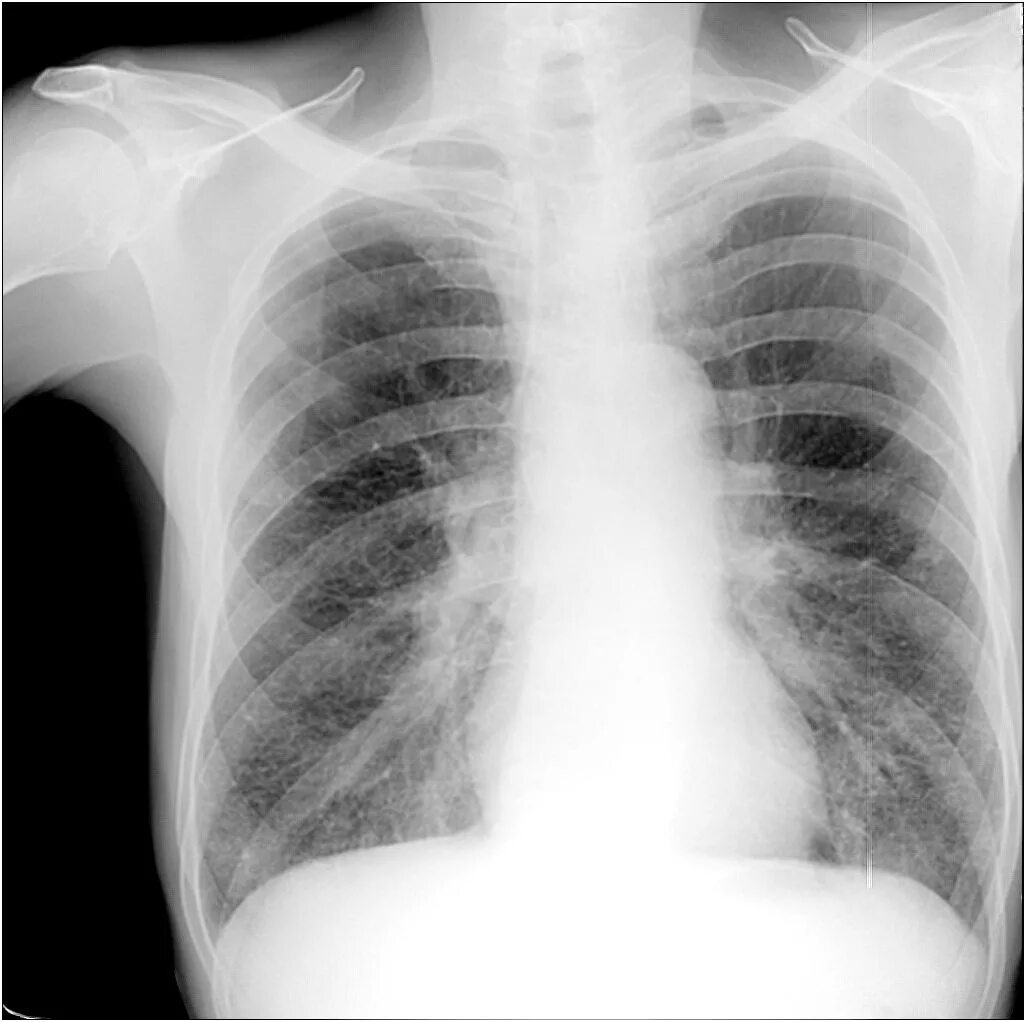 Диффузный пневмосклероз это рак. Пневмосклероз рентгенограмма. Тотальный пневмосклероз. Кардиогенный пневмосклероз. Пневмосклероз рентген.