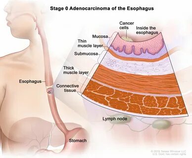 Esophageal cancer
