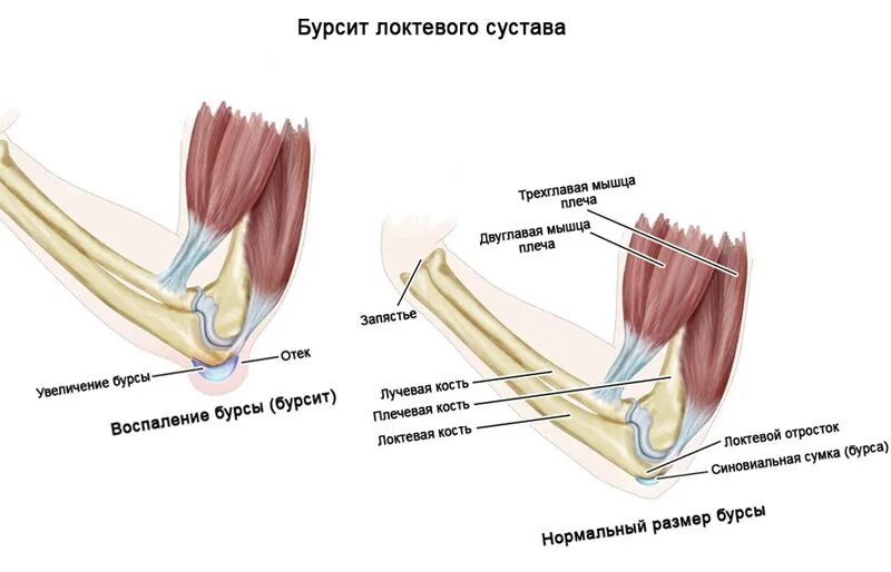 Болят локти причина и лечение у женщин. Бурсит локтевого отростка. Синовиальные сумки локтевого сустава бурсит. Бурсит локтевого сустава анатомия. Бурсит сустава локтя жидкость.