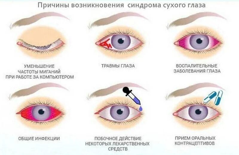 Синдром сухого глаза симптомы. Причины возникновения синдрома сухого глаза. Синдром сухого глаза симптомы причины развития. Признаки синдрома сухого глаза