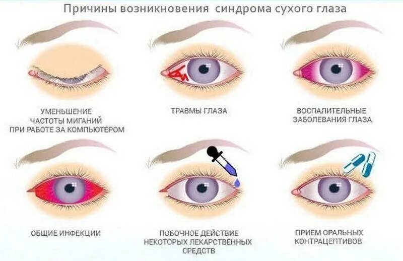 Почему уменьшился глаз. Синдром сухого глаза симптомы. Коньюктивит коньюктивит коньюктивит. Причины развития синдрома сухого глаза. Признаки синдрома сухого глаза.