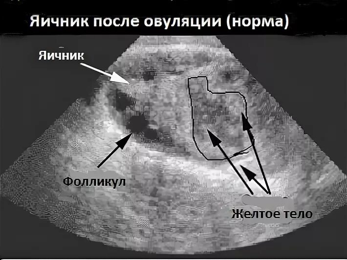 Вместо овуляции. Жёлтое тело в яичнике на УЗИ. Яичники на УЗИ норма.