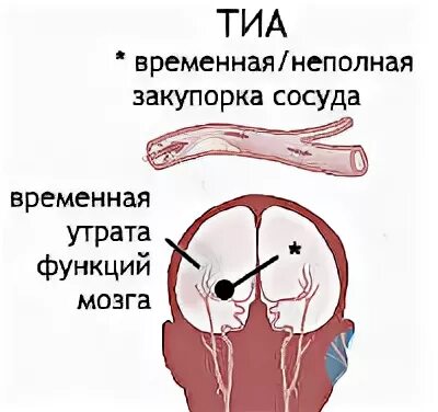 Ишемическая атака головного мозга последствия. Транзиторная ишемическая атака головного мозга симптомы. Транзиторная ишемия головного мозга. Транзиторная ишемическая атака клиника. Тиа симптомы в неврологии.