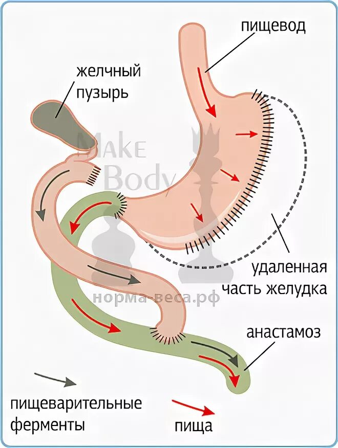 После удаления части желудка. Билиопанкреатическое шунтирование желудка что это. Продольная резекция желудка после операции. Билиопанкреатическое шунтирование (БПШ). Продольная резекция желудка (ПРЖ).