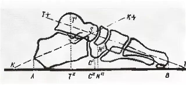 Перелом пяточной кости угол. Пяточный угол норма. Угол белера при переломе пяточной кости. Пяточный угол норма. Пяточный угол норма.