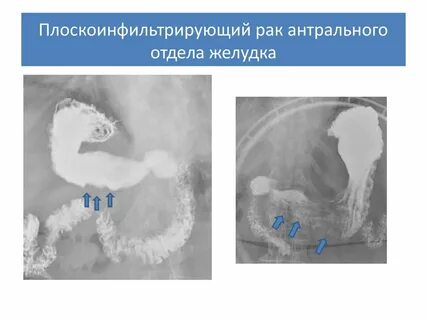 Атрофия отдела желудка