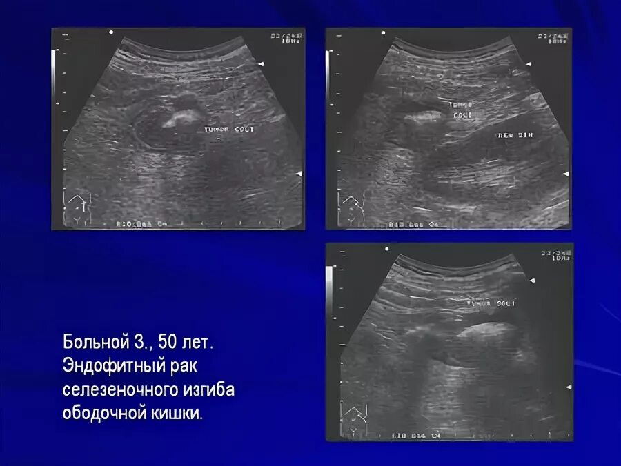 Ободочная кишка узи. Непроходимость кишечника на узи. Новообразование кишечника на узи. Патология кишечника на узи. Ободочная кишка узи.