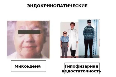 Микседема при гипотиреозе