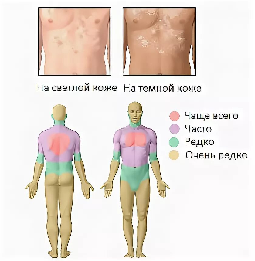 Цветной лишай фото признаки и лечение Что такое дерматомикозы