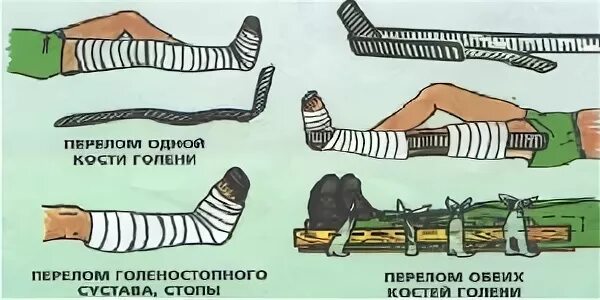 Кровотечение при открытом переломе голени. Перелом берцовой кости иммобилизация. Транспортная иммобилизация при переломах костей голени и стопы.. Перелом голени первая помощь иммобилизация. Иммобилизация костей голени шиной Крамера.