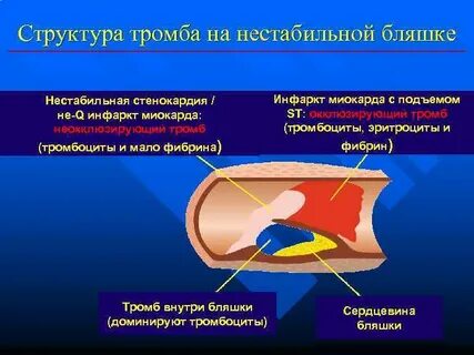 Структура тромба