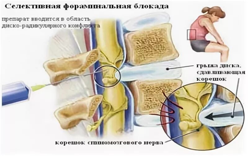 Блокада грыжи цена. Препараты для блокады грыжи поясничного отдела. Блокада межпозвонкового диска и грыжи. Блокада грыжи позвоночника. Блокада грыжа межпозвоночного диска.