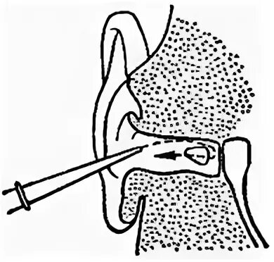 Как промыть уши самому в домашних условиях. Серная пробка отоскопия. Шприц для промывания серной пробки. Алгоритм промывания серной пробки. "Серная пробка отоскопическая картина".
