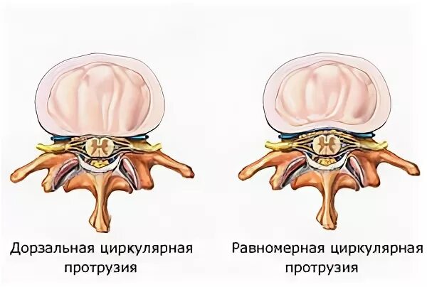 Циркулярное выбухание диска l4/l5.. Циркулярная протрузия диска l5-s1. Циркулярно дорсальная протрузия межпозвоночного диска. Циркулярная протрузия межпозвонкового диска l5-s1. Диффузная протрузия межпозвонковых