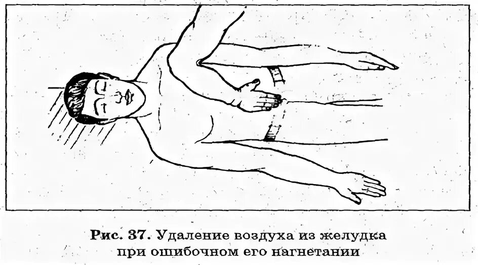 Удаление воздуха из желудка при искусственном дыхании. Искусственное дыхание при устранении воздуха из желудка. Искусственное дыхание для удаления воздуха из желудка необходимо. При искусственном дыхании для удаления воздуха из желудка необходимо. Удаление воздуха из желудка пострадавшего.