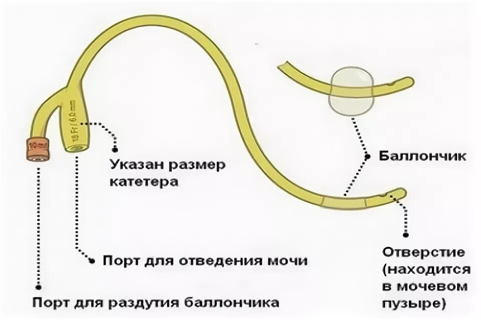 Куда вставляется катетер. Надлобковый мочевой катетер фолея. схема установки мочевого катетера. катетер фолея цистостомический. катетер фолея схема установки.