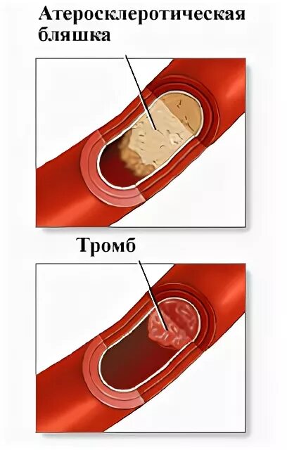 Аортокоронаросклероз легких что это такое