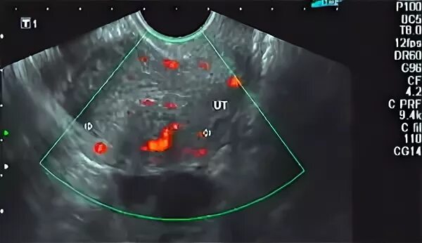 Эхо аденомиоза. Очаговый аденомиоз на УЗИ.
