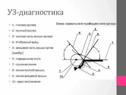 Типы тазобедренных суставов по графу