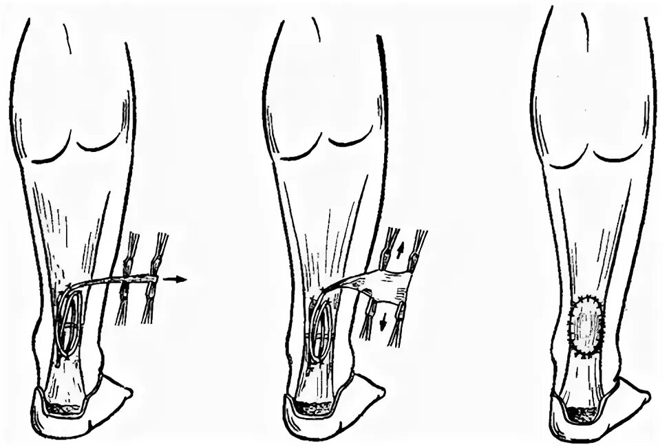 Разрыв ахиллова сухожилия операция. Операция на ахиллова сухожилия пластика. Ахиллово сухожилие растяжение. Ахиллово сухожилие разрыв ахиллова сухожилия