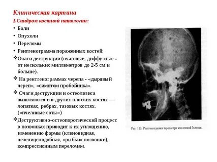 Синдром костей
