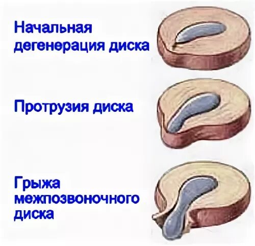 3 Протрузии. Протрузия межпозвонковых дисков. Протрузия дисков позвоночника что это такое. Физиологическая протрузия.