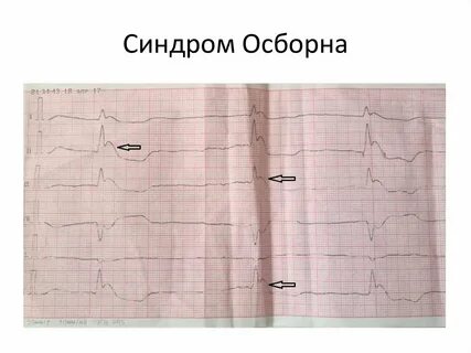 Зубец осборна на экг