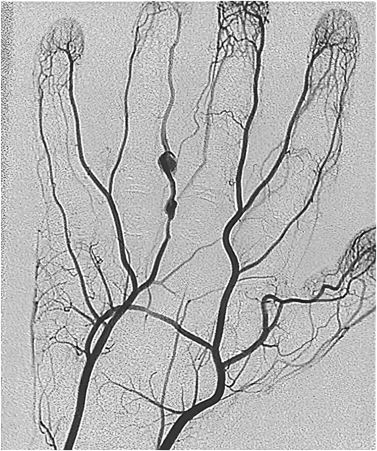 Ангиография периферических сосудов. Ангиография артерий кисти. Ангиография верхних конечностей. Ангиография сосудов верхних конечностей. Повреждение мелких артерий кистей и стоп