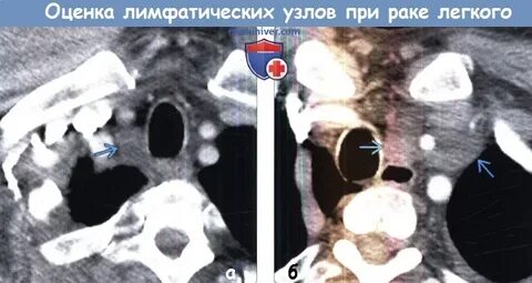 Забрюшинная лимфаденопатия что это